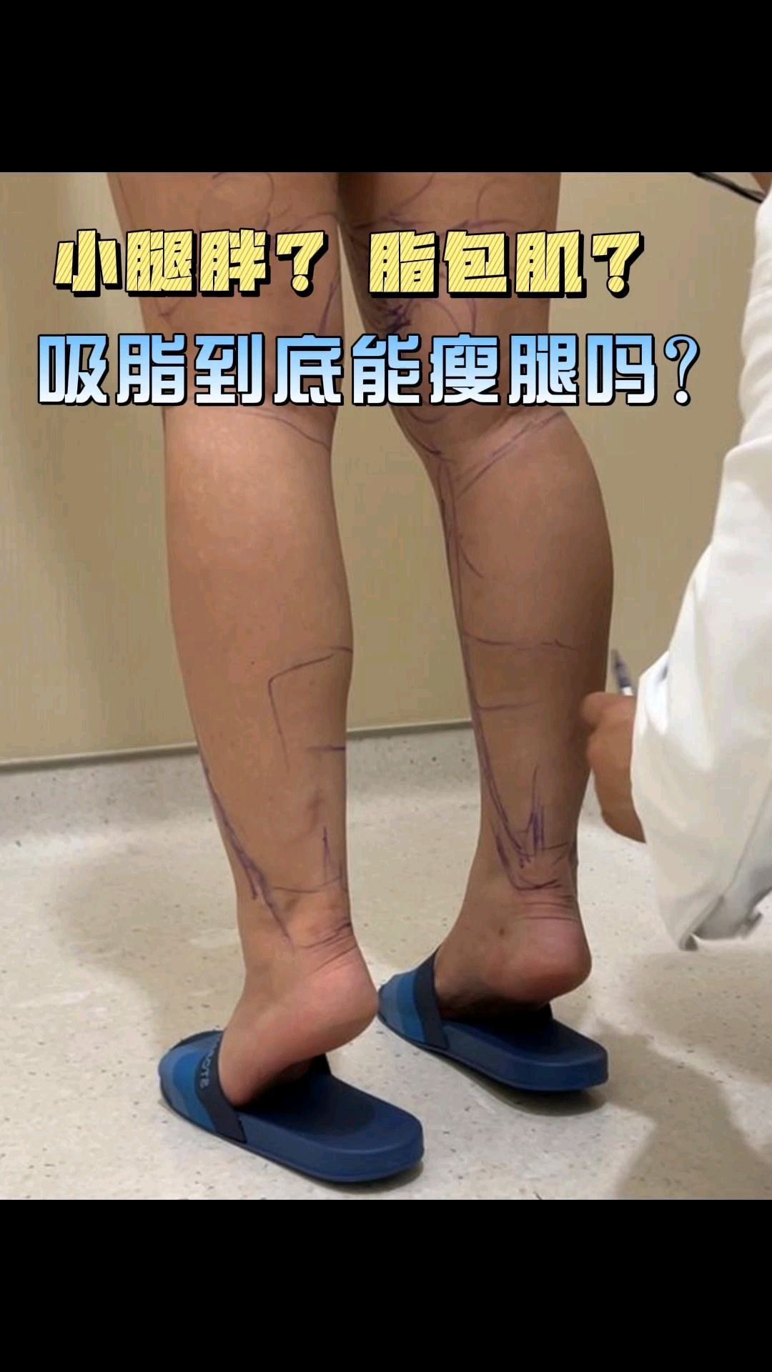 小腿肌肉比较多能不能吸脂呢?