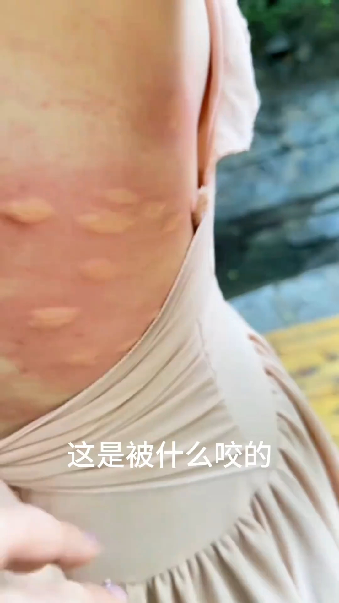 分享一些被昆虫咬后的症状