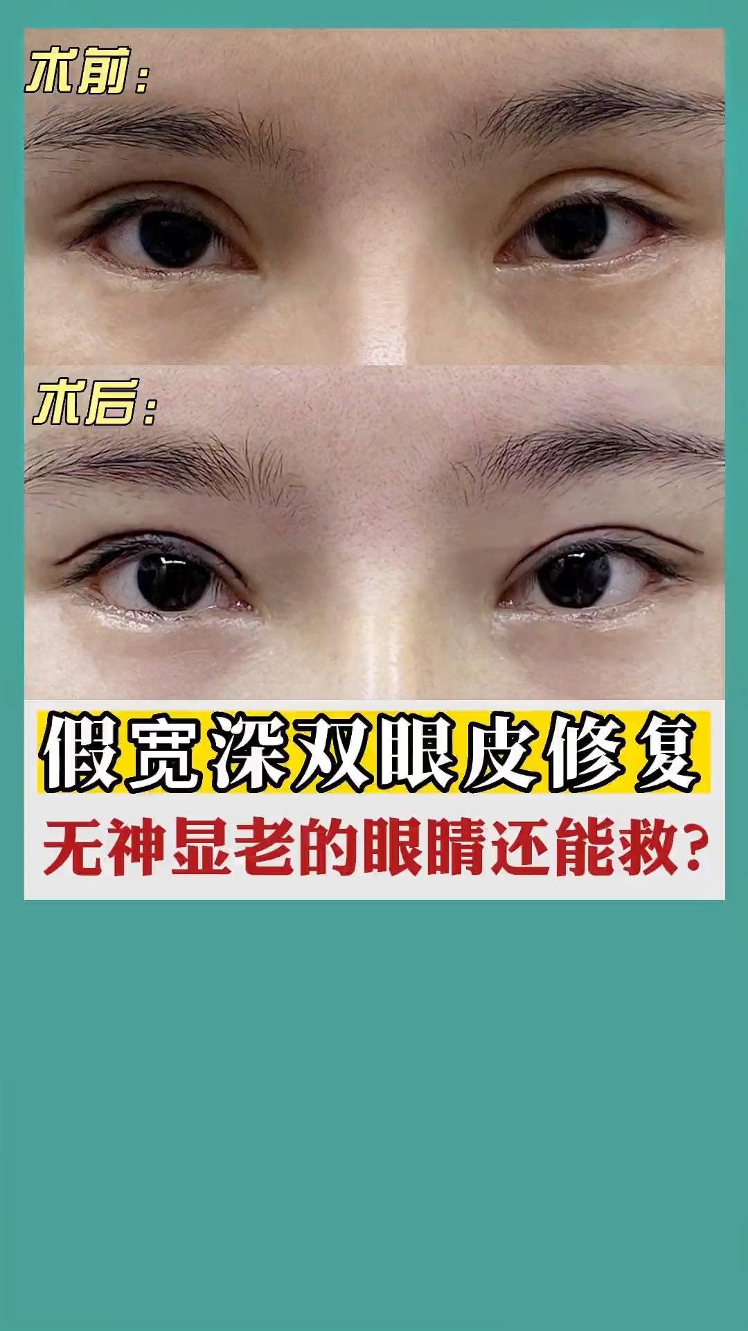 假宽深双眼皮修复,无神显老的眼睛还能有救吗?