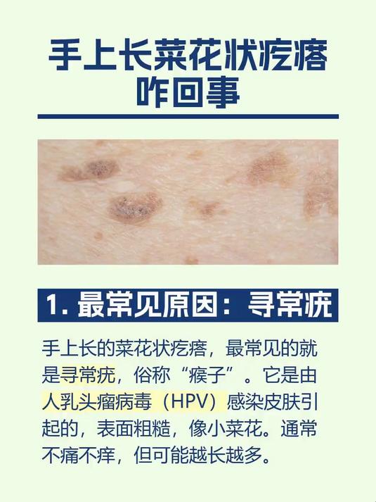 手上长菜花状疙瘩咋回事