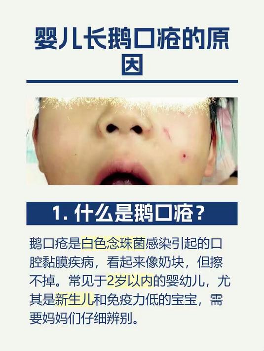 #马上健康过大年#婴儿长鹅口疮的原因