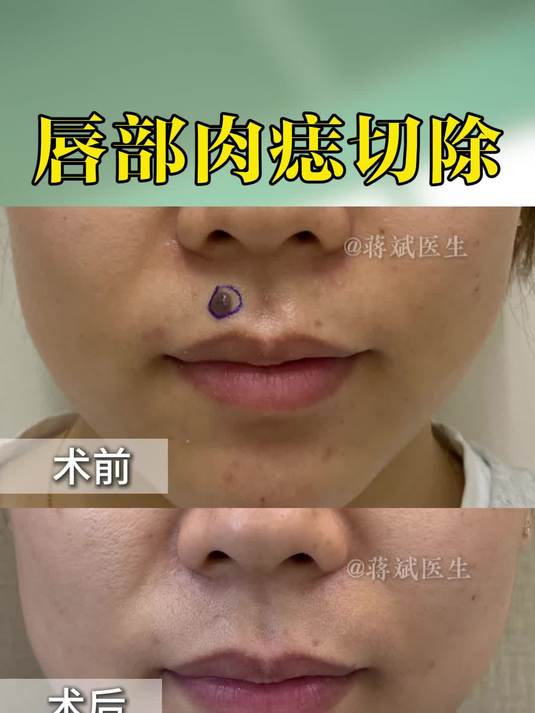 唇部位置特殊,既是美观焦点又是功能区域,所以手术需要格外谨慎