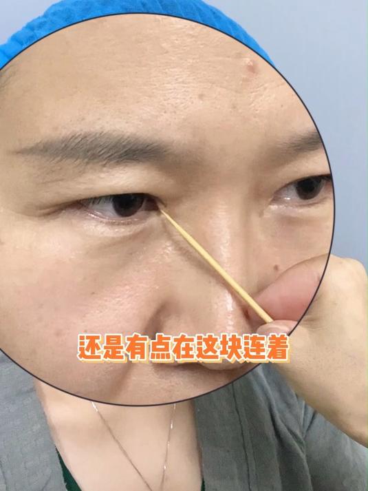 内眼角开大没形成?