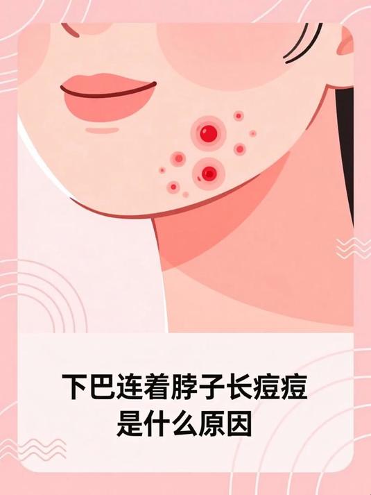 下巴连着脖子长痘痘是什么原因