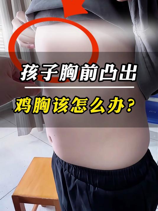 孩子胸前凸出“鸡胸”,是因为坐姿不好?
