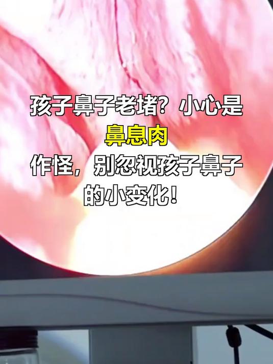 小孩鼻息肉怎么引起的