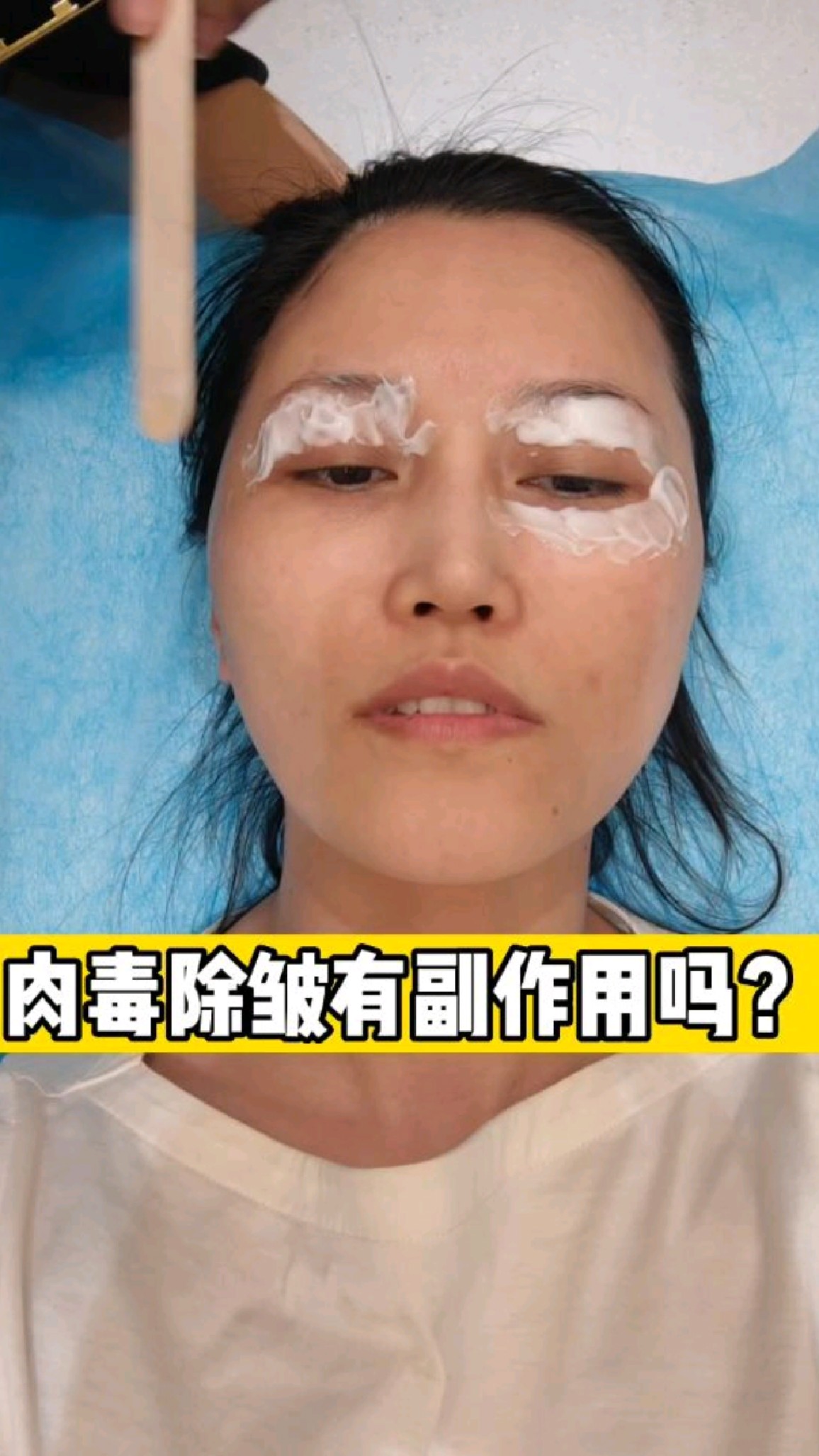 打肉毒除皱有副作用吗?