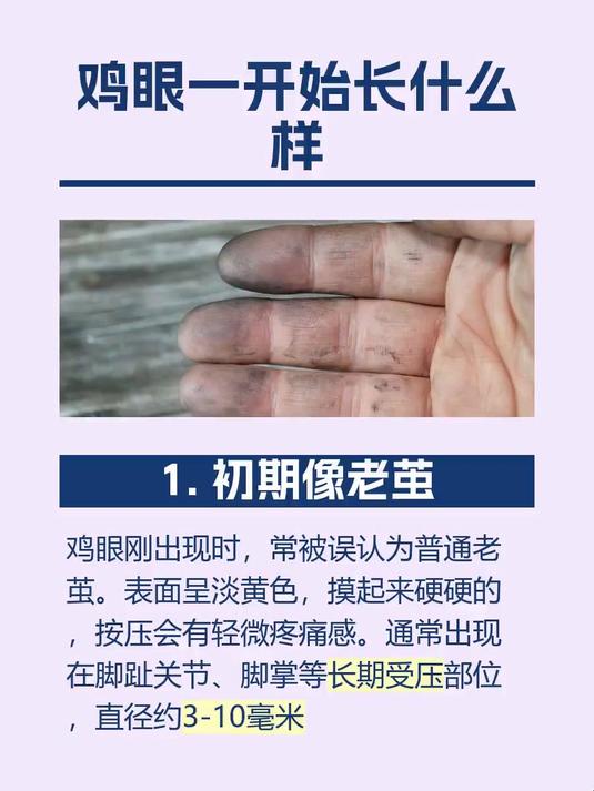 鸡眼一开始长什么样