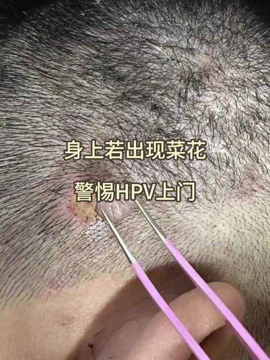 身上若出现菜花,警惕HPV找上门