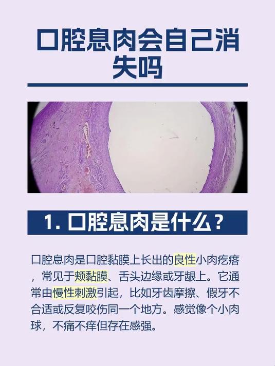 #马上健康过大年#口腔息肉会自己消失吗
