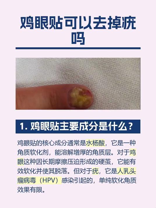 鸡眼贴可以去掉疣吗
