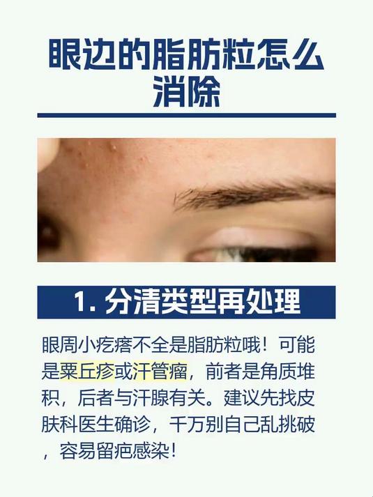眼边的脂肪粒怎么消除