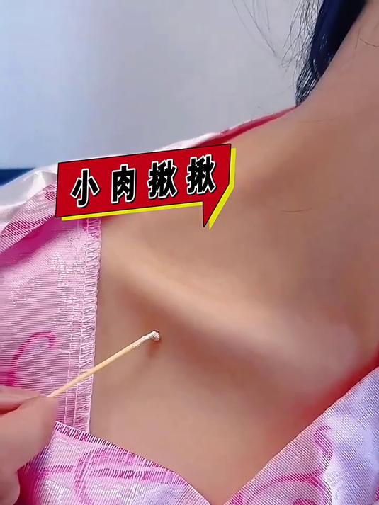 告别瘊子肉粒,拥抱光滑肌肤!