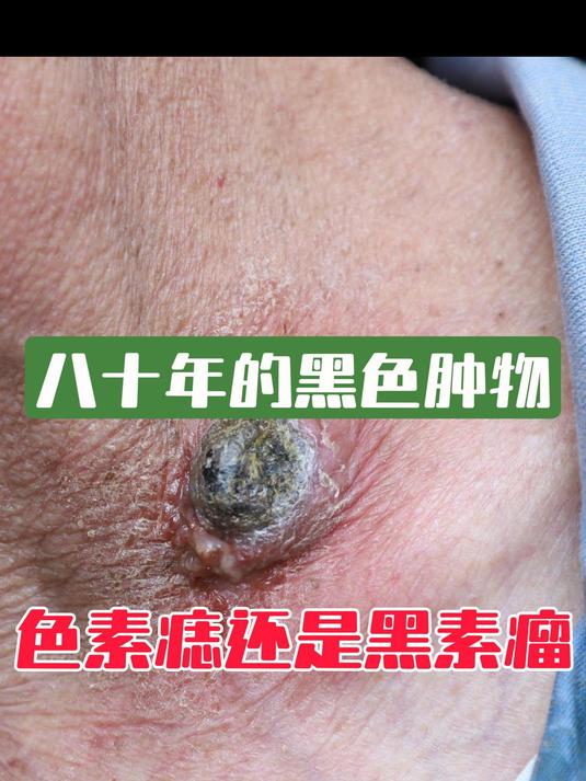 八十年的黑色肿物色素痣还是黑素瘤