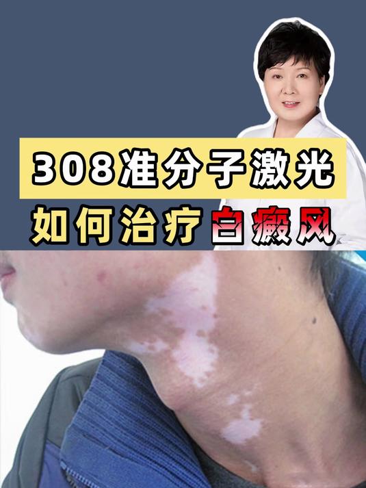 308准分子激光是怎么治疗白癜风的