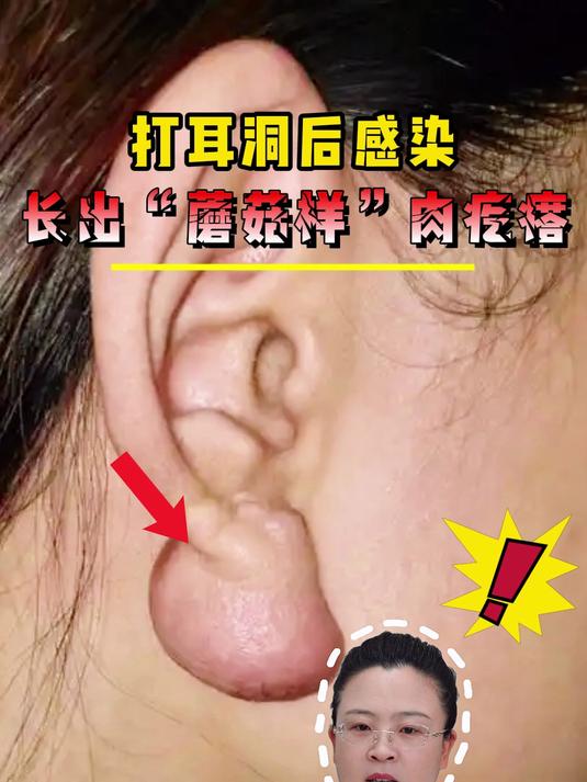 打耳洞后感染长出“蘑菇样”肉疙瘩!