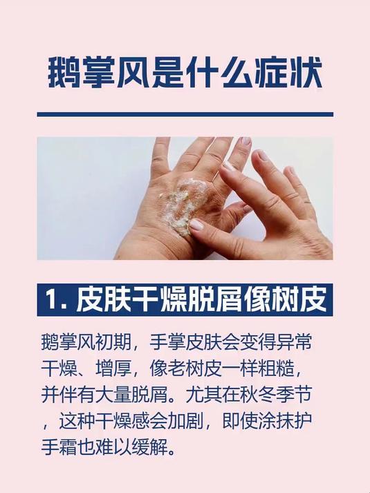鹅掌风是什么症状