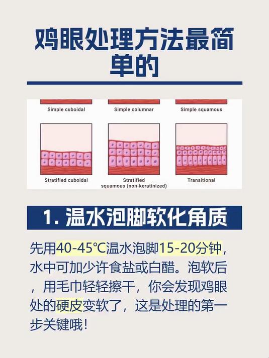 鸡眼处理方法最简单的