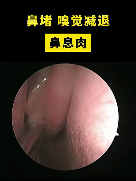 鼻堵 嗅觉减退 鼻息肉