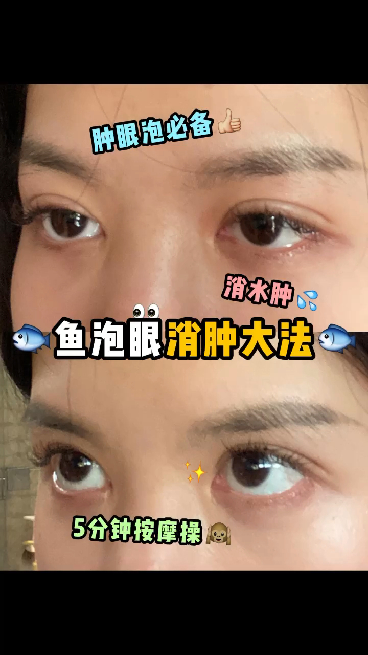 鱼泡眼消肿大法