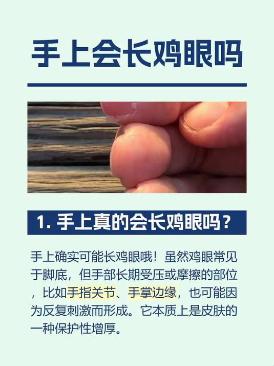 #马上健康过大年#手上会长鸡眼吗