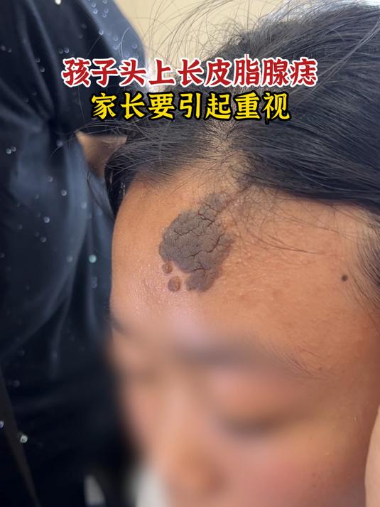 孩子头上长皮脂腺痣,家长要引起重视