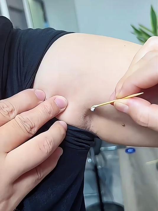 专祛脖子肉赘腋下脂肪粒!