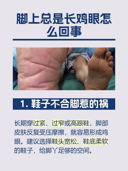 脚上总是长鸡眼怎么回事