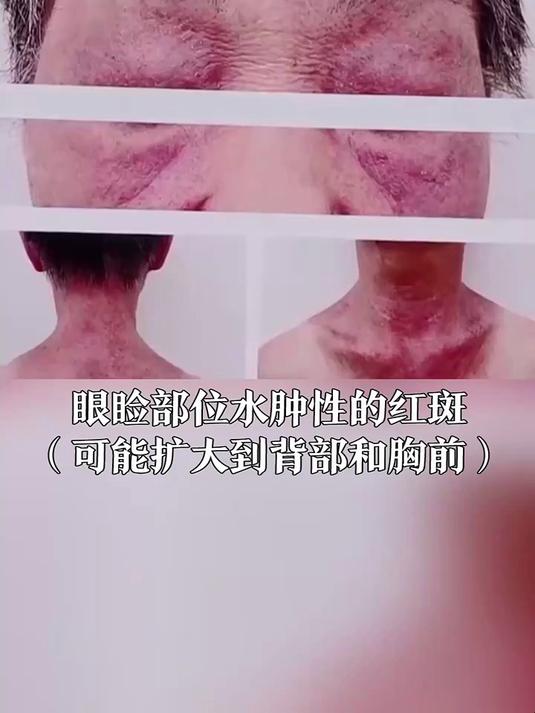 眼睛周围长这种红点 当心是癌症信号