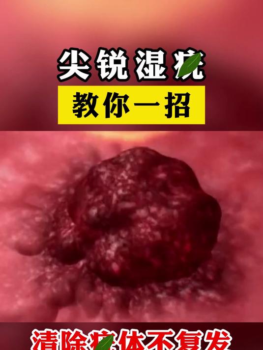 尖锐湿疣,教你一招,清除疣体不复发