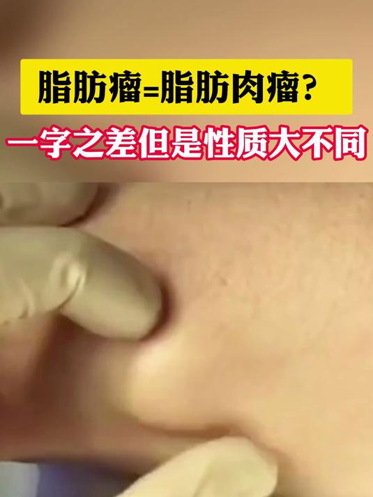 脂肪瘤=脂肪肉瘤?一字之差但是性质大不同