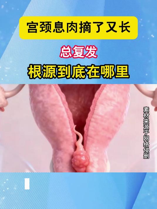 宫颈息肉摘了又长,总复发,根源到底在哪里#健康向阳计划#