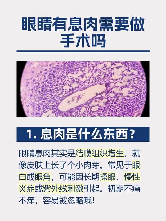 眼睛有息肉需要做手术吗