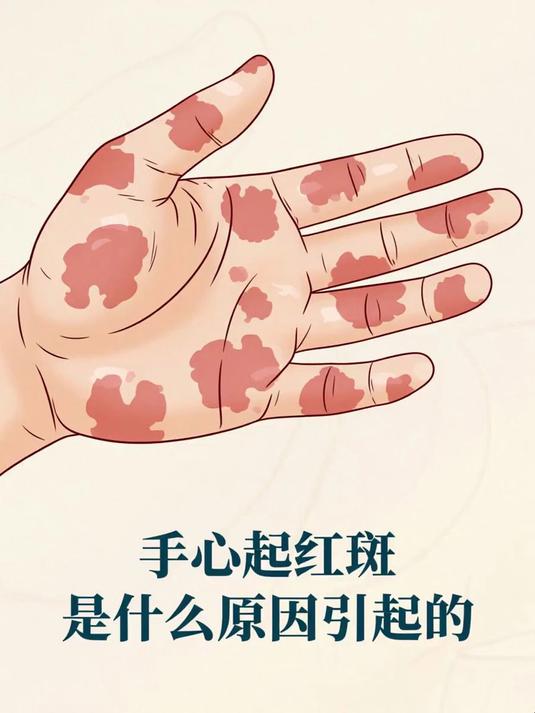 手心起红斑是什么原因引起的 #健康扬帆季#