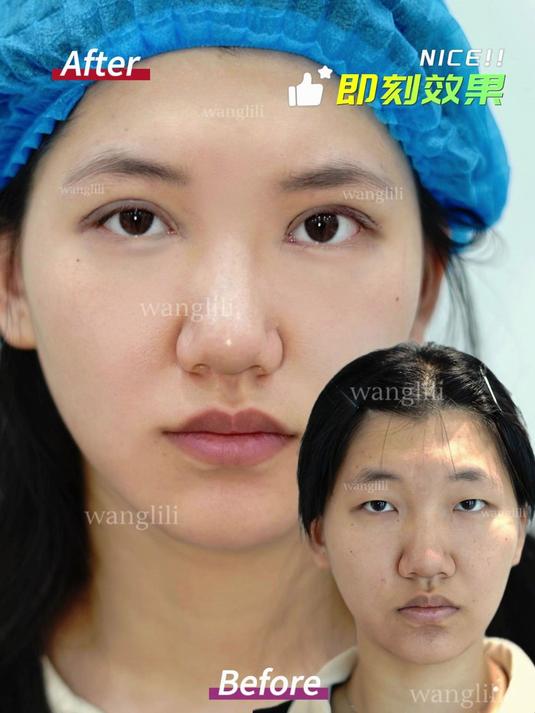 从单眼皮到双眼皮:医生亲晒患者术后即刻图,效果真实到不敢信!