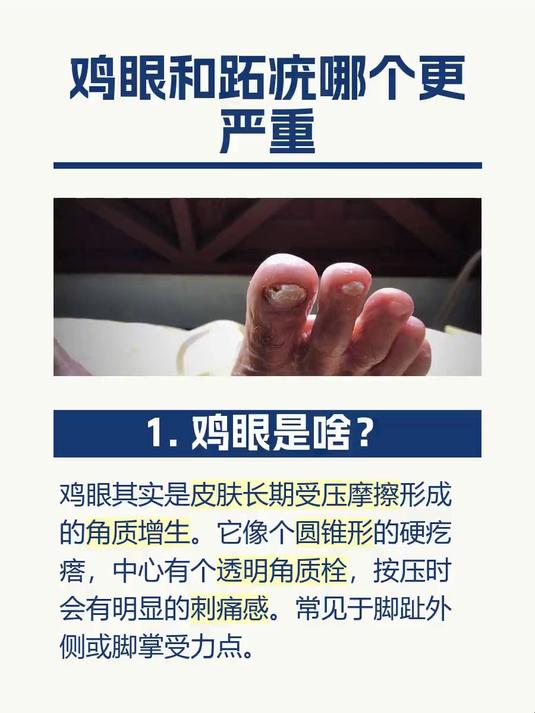 鸡眼和跖疣哪个更严重