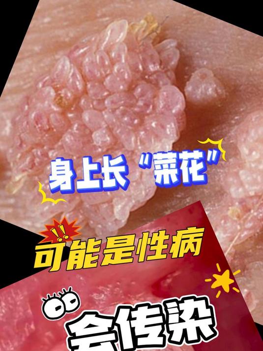 身上长菜花,可能是性病会传染