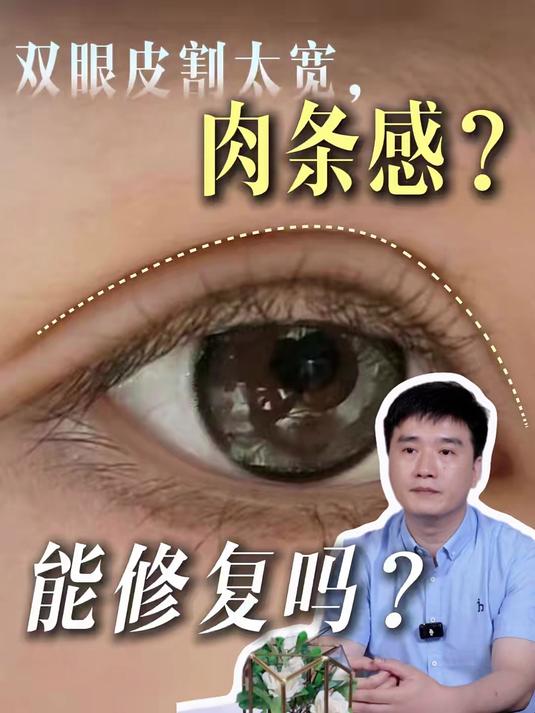 双眼皮割太宽肉条感重怎么办，可以修复吗