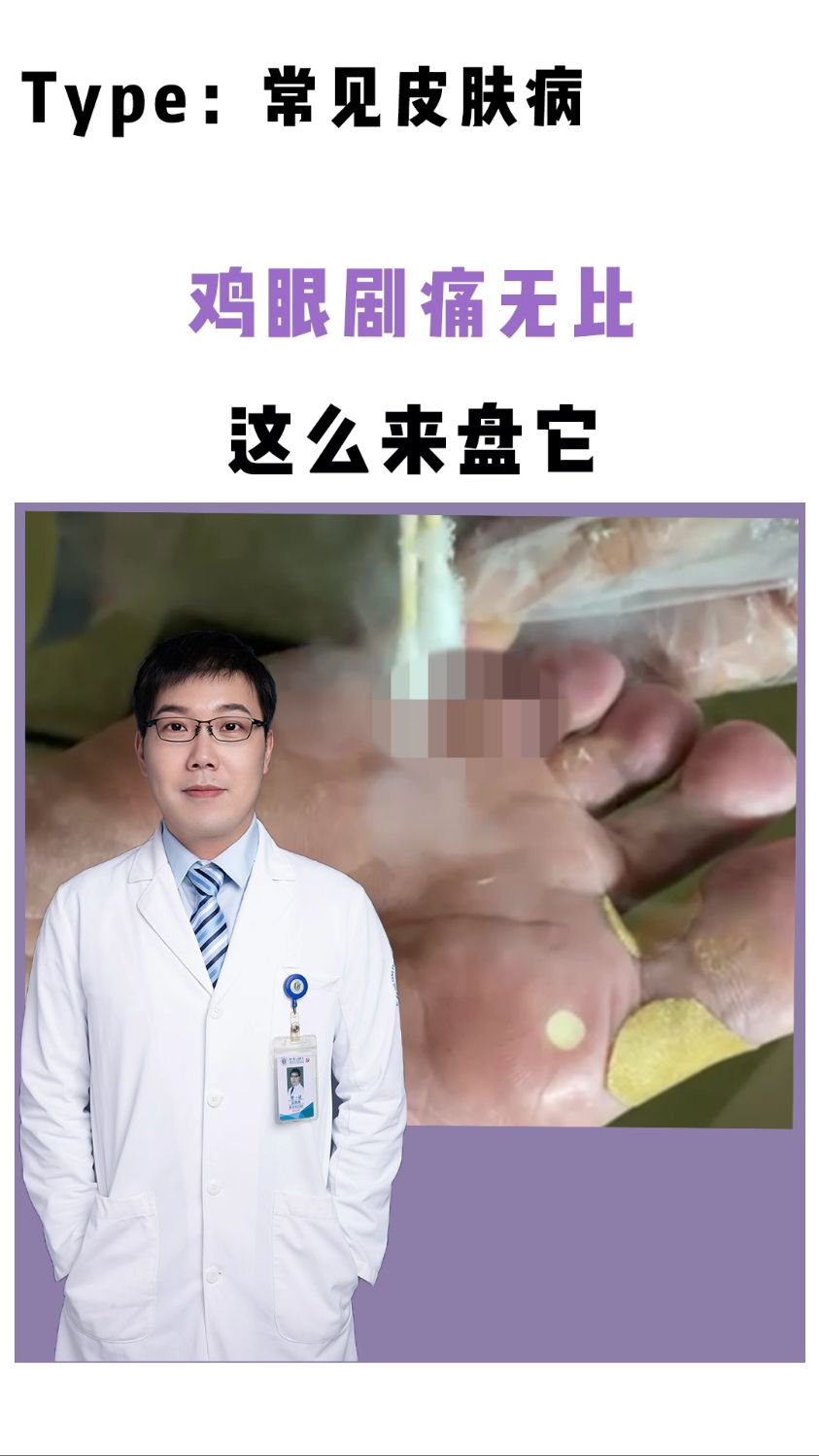 美女冷冻鸡眼,从头到尾直喊“疼”!