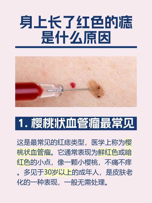 #马上健康过大年#身上长了红色的痣是什么原因