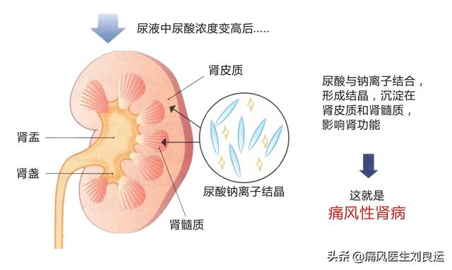 章鱼直播足球即时比分能降尿酸,我何必要不吃非布司他?碱化尿液并无法清领痛风