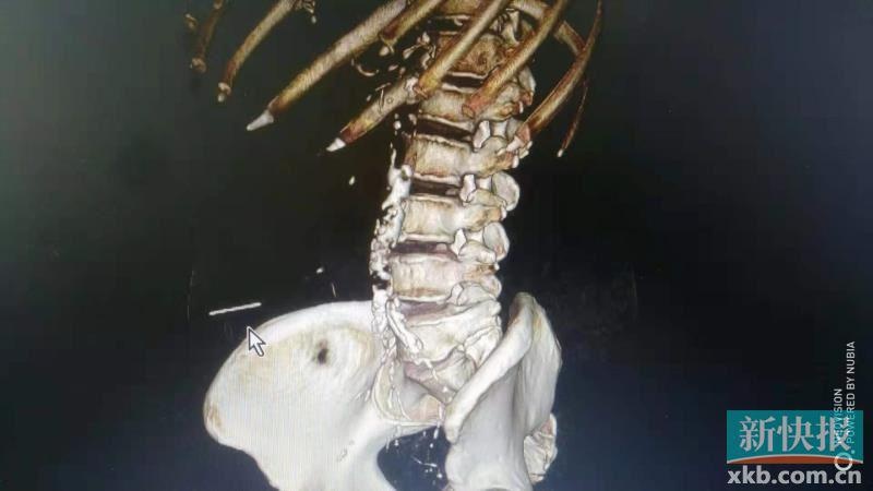 惊险!广州67岁阿婆自行针灸,针断腹中……