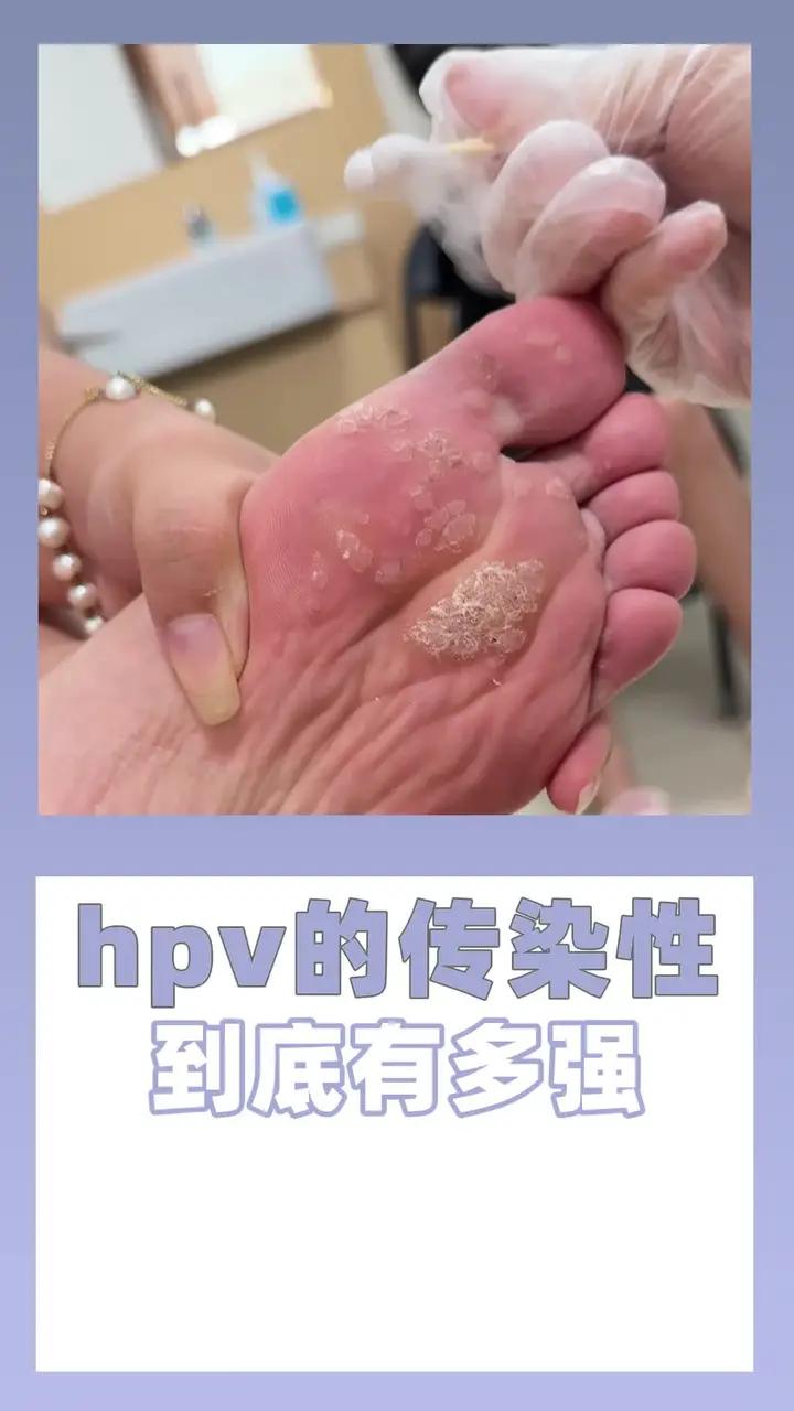 体验-196℃的酸爽,这是一个跖疣患者 跖疣是由hpv病毒感染引起的,它刚开始只是一个粗糙