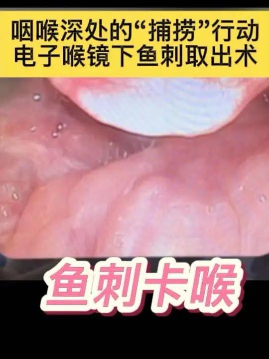 咽喉深处的“捕捞”行动:电子喉镜下鱼刺取出术 卡在喉咙的“尖刀”!医生如何用“电子眼”巧妙