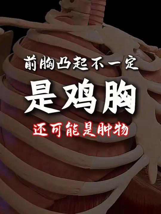 2岁宝宝胸部凸起,家长开始以为是鸡胸,检查后发现是肿物,已切除。接触过不少鸡胸和肿物分不清