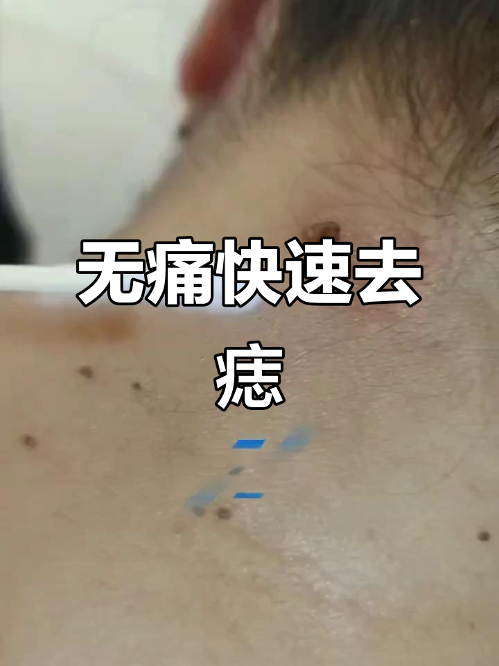 轻松祛痣,无痛无忌口,秒变干净!
