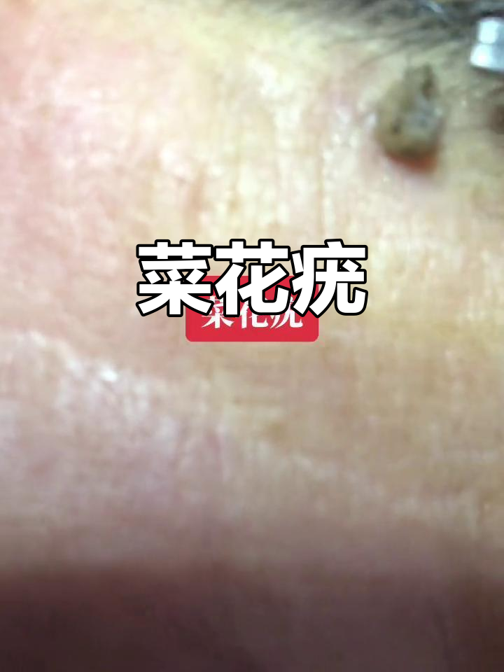 头部菜花状疣体