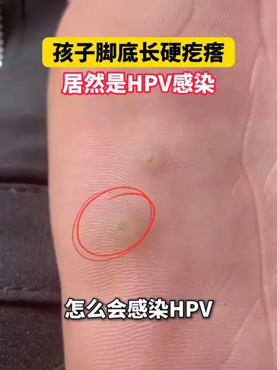 孩子也会感染hpv!家长千万别大意,小心越长越多……