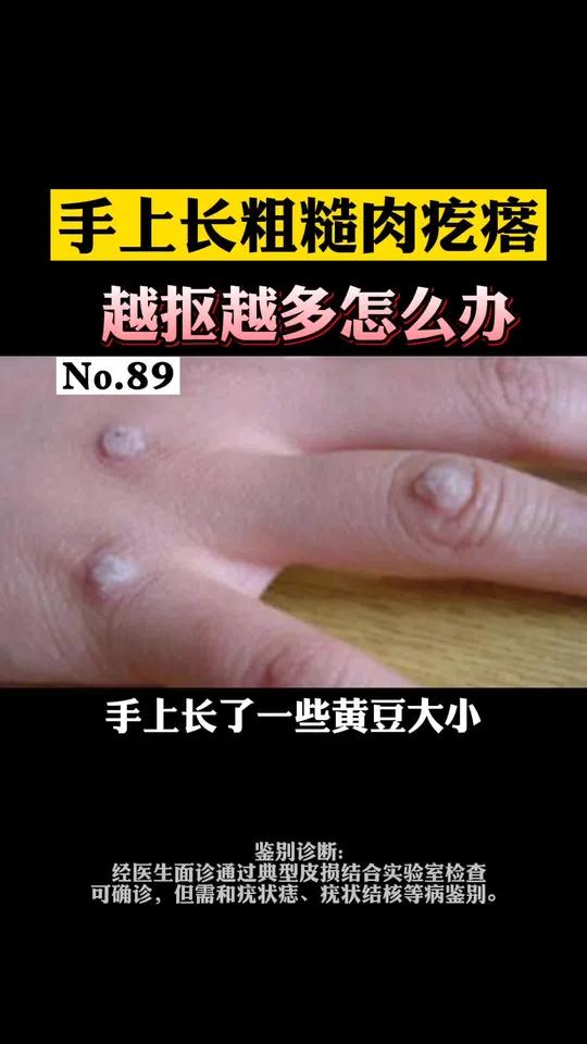 手上长这种肉疙瘩,别大意,会传染!寻常疣瘊子可以怎样处理