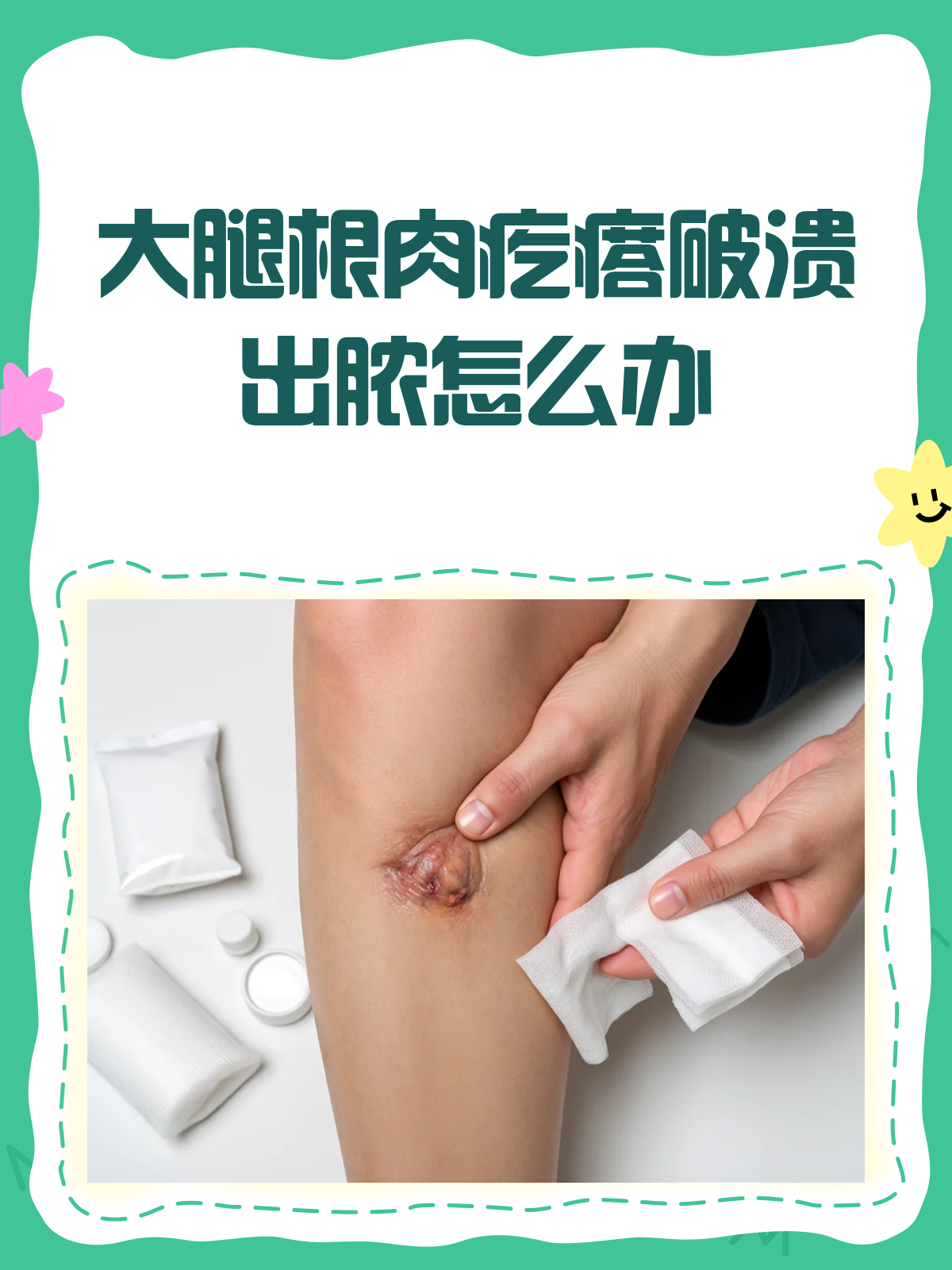大腿根肉疙瘩化脓破溃?别急,一文读懂!